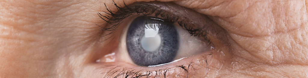 Recurrent Erosion Syndrome