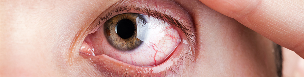 Cornea Abrasion
