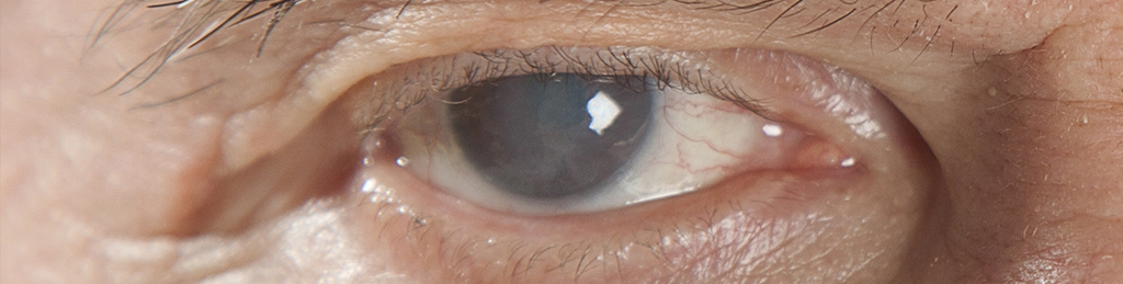 Cornea Edema