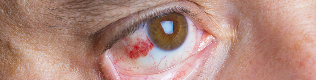 Cornea Dystrophy